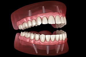 Upper and lower implant dentures