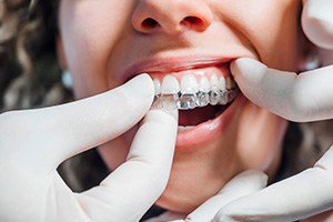 Dentist putting clear aligner on patient