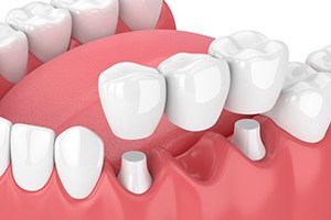 diagram of dental bridge being placed in mouth 