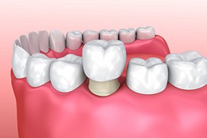 diagram of dental crown being placed on tooth 