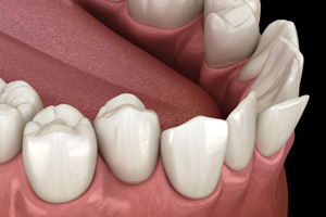 Illustration of crowded teeth