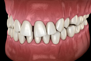 Illustration of gapped teeth