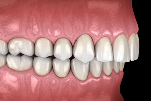 Illustration of an overbite