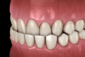 Illustration of an underbite