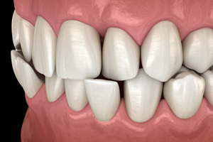 Illustration of a crossbite