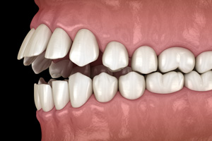 Illustration of an open bite