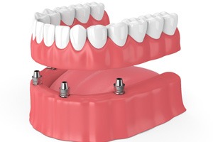 Render of implant dentures in South Portland, ME with six implant posts