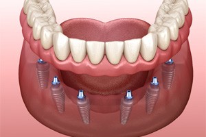 Senior woman smiling outside with implant dentures in South Portland, ME