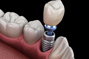 Render of dental implant in South Portland, ME replacing a single tooth