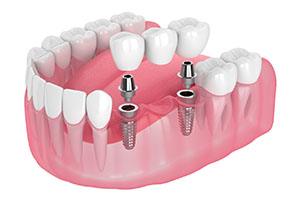 Render of dental implants in South Portland, ME supporting a bridge