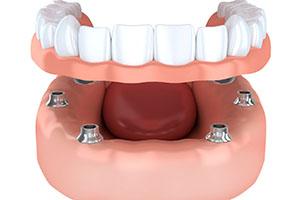 Render of dental implants in South Portland, ME supporting dentures