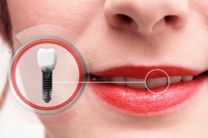 close-up of a person with dental implants in South Portland, ME