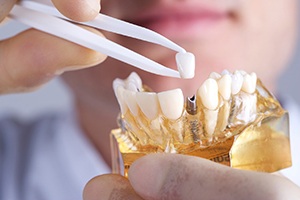 dentist putting a crown on top of a dental implant