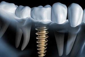 X-ray of a person with a single dental implant