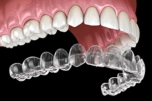 A digital image of an Invisalign aligner preparing to go on over the top row of teeth