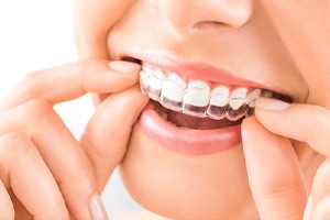 Woman wearing Invisalign aligner