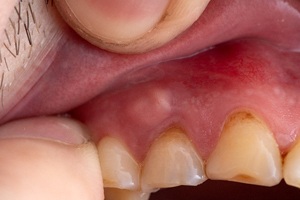 person with a bump on their gums