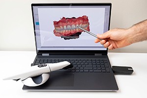 a hand pointing to a digital impression of a mouth on a laptop with an intraoral scanner resting on the keyboard