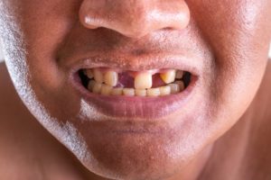 close up of a man with missing teeth