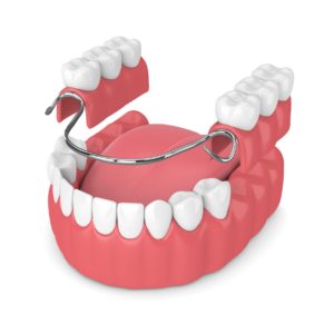 Model showing a partial denture