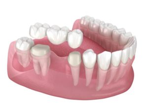 dental bridge 3D illustration