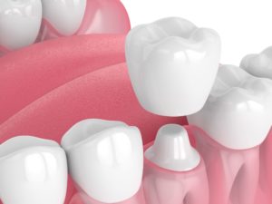 Illustration of a dental crown over a pared down tooth