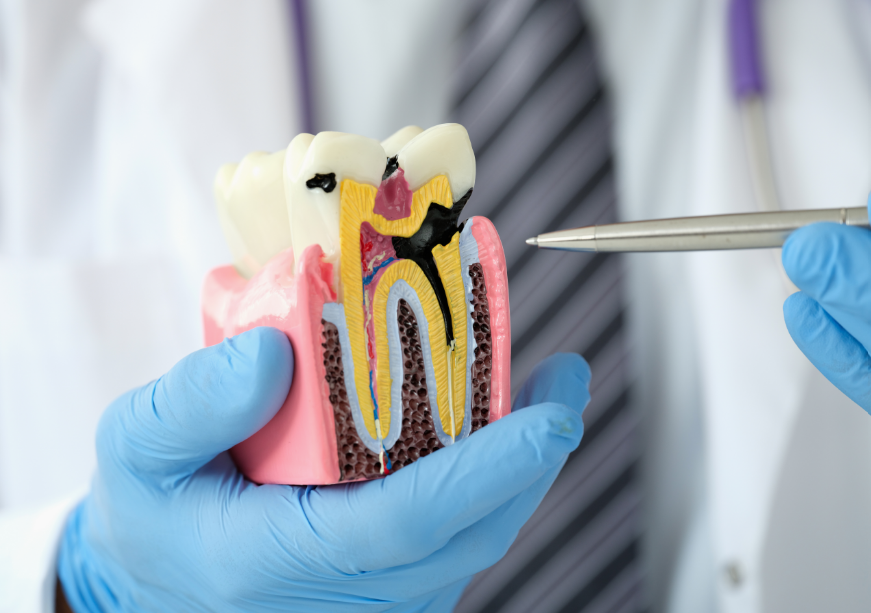 Model of tooth with cavity